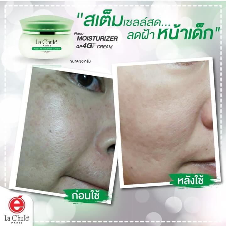 review how to clear melasma รีวิวฝ้า
