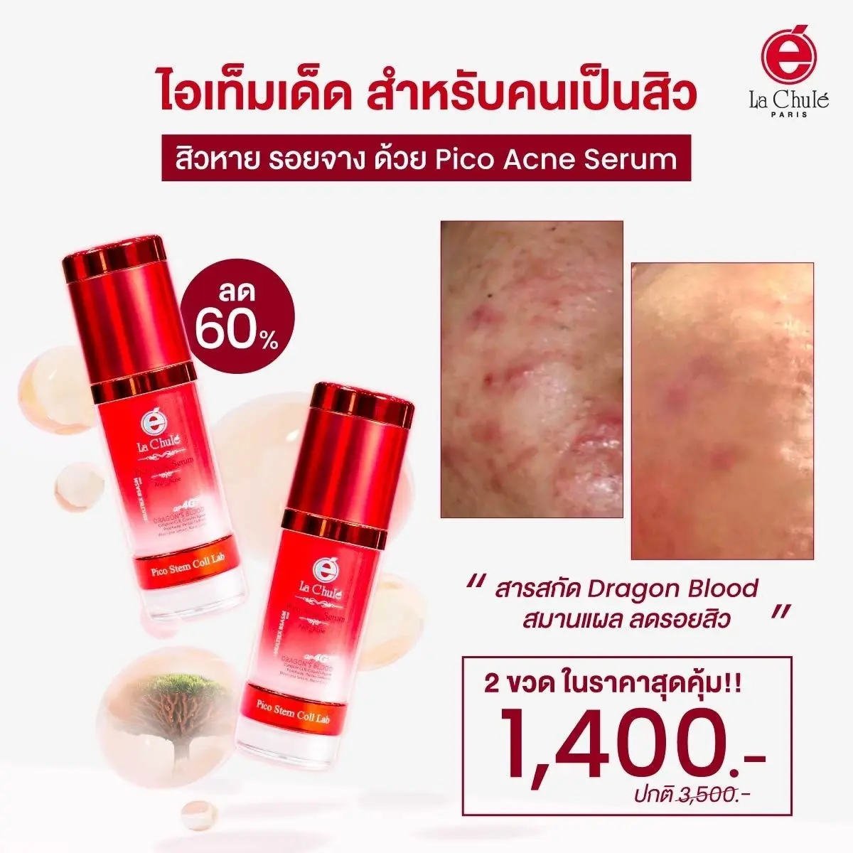 พิโก แอคเน่ ซีรั่ม